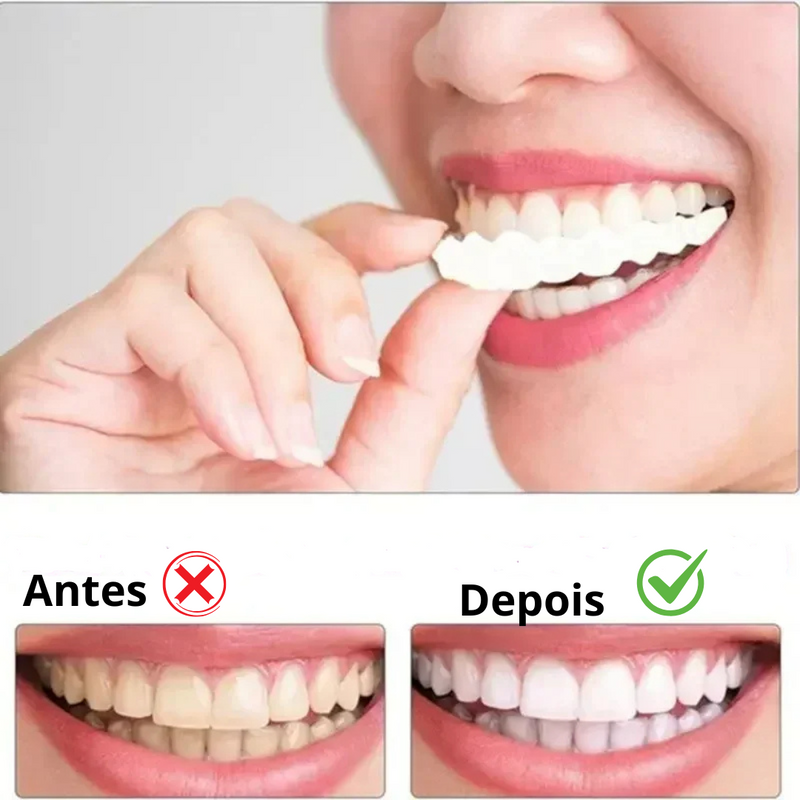 [ 🔥 BRECK FRIDAY 🔥 ] Lente Smile Odontológicas Removíveis - Resina 3M™ Fil Tek™