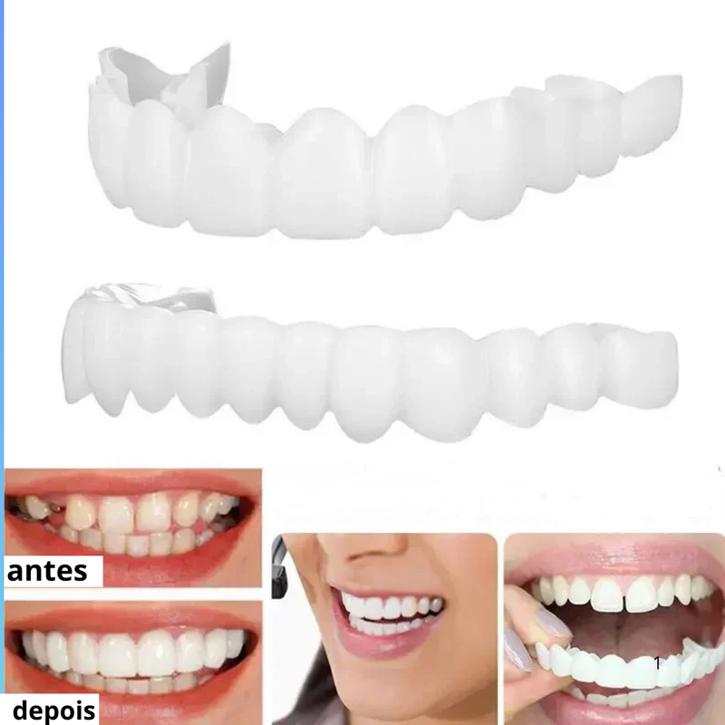 [ 🔥 BRECK FRIDAY 🔥 ] Lente Smile Odontológicas Removíveis - Resina 3M™ Fil Tek™